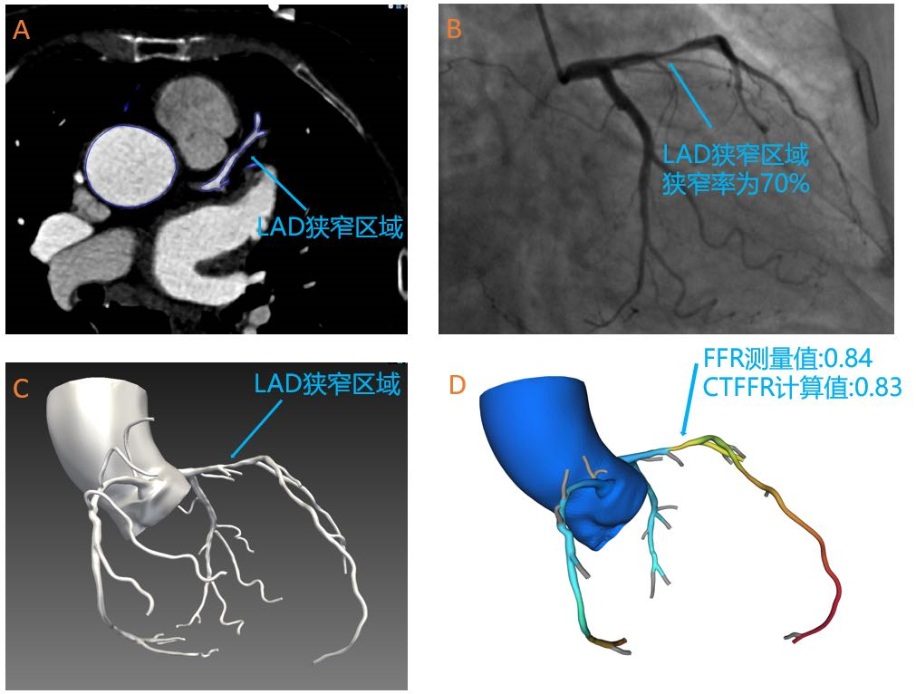 奧泰康助力睿心醫(yī)療&mdash;《冠狀動脈供血功能（CT-FFR）評估軟件》產(chǎn)品完成創(chuàng)新審評及臨床試驗